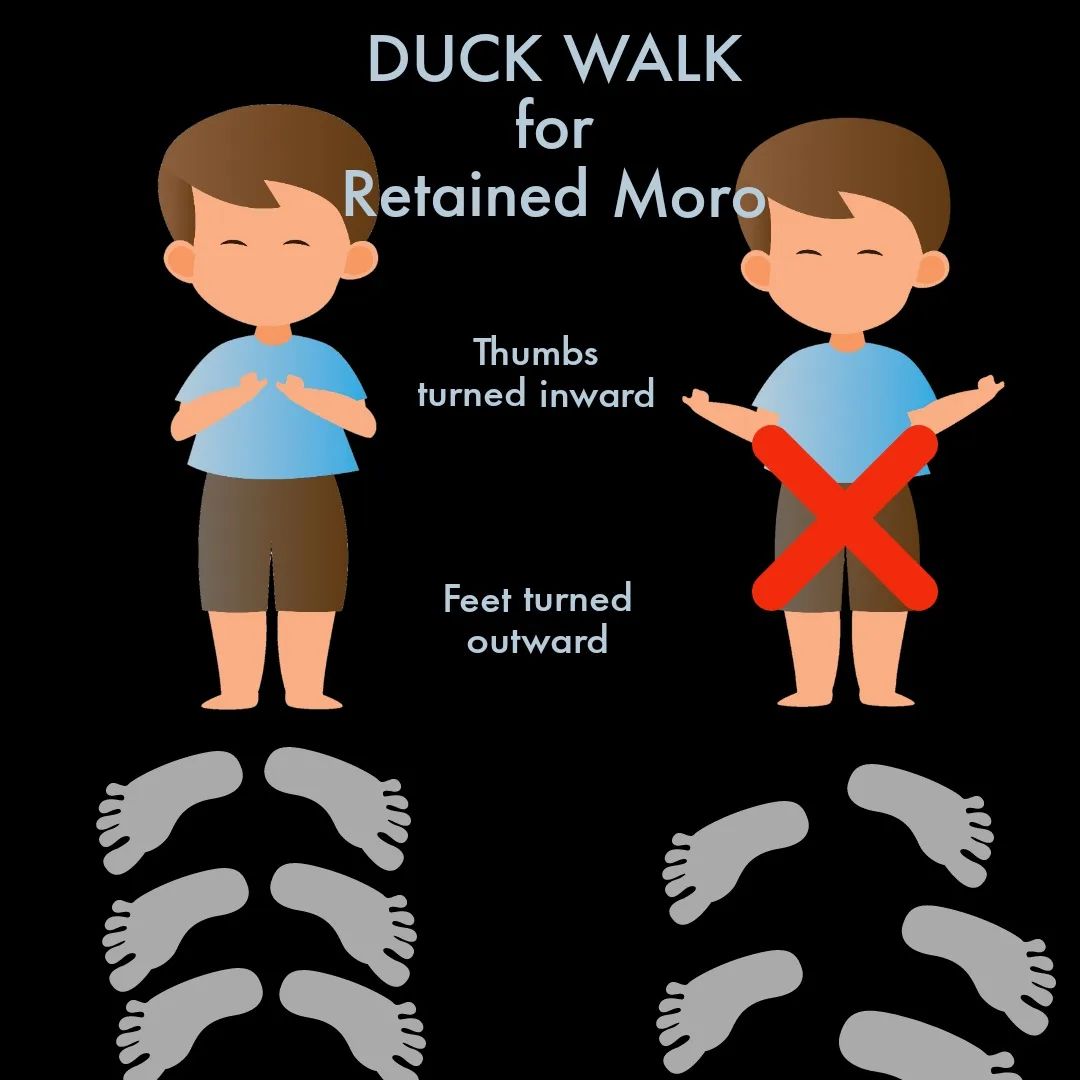 Duck Walk for Retained Moro