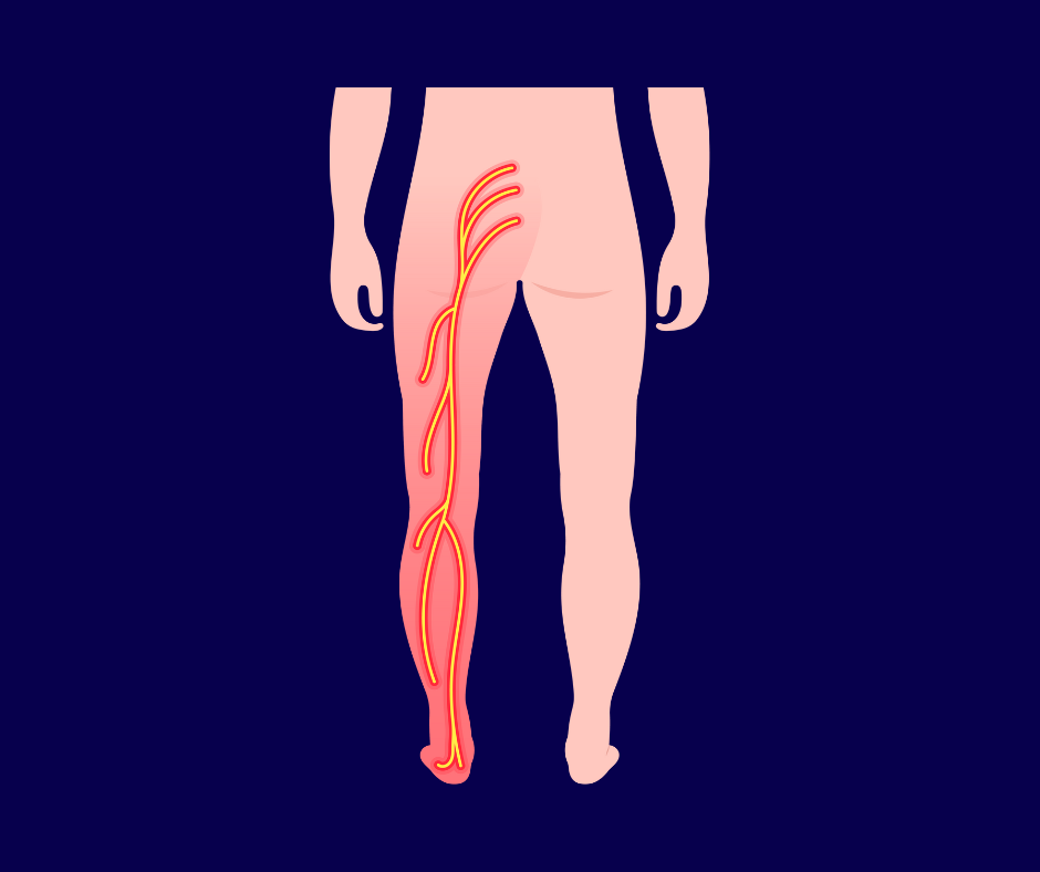 Chiropractor for Sciatica in Birmingham & Homewood, AL: Natural Relief Without Medications